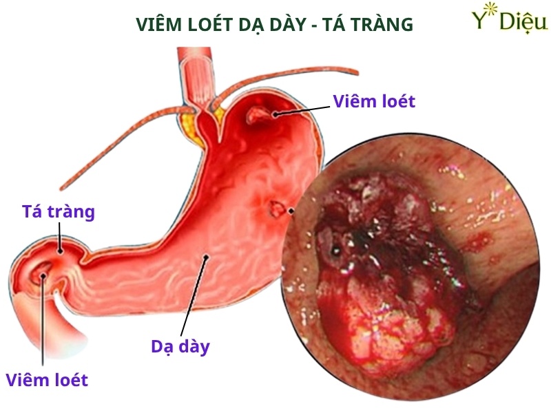 Lá Khôi trong cao dạ cẩm giúp trung hòa axit và chống viêm loét dạ dày