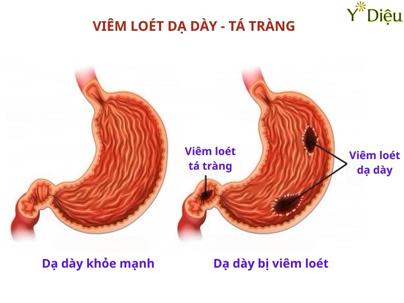Viêm Dạ Dày: Nguyên Nhân, Triệu Chứng Và Cách Điều Trị