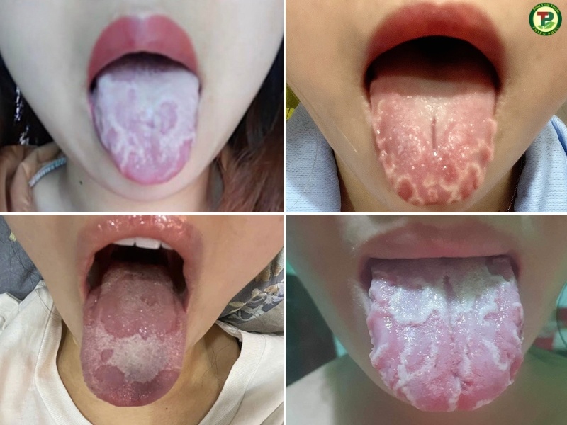 Hình Ảnh Viêm Lưỡi Bản Đồ Và Cách Điều Trị