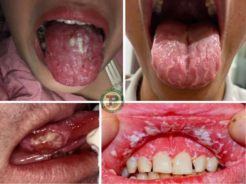 Những biến chứng nguy hiểm của bệnh nấm lưỡi trăng, nếu không được điều trị kịp thời.