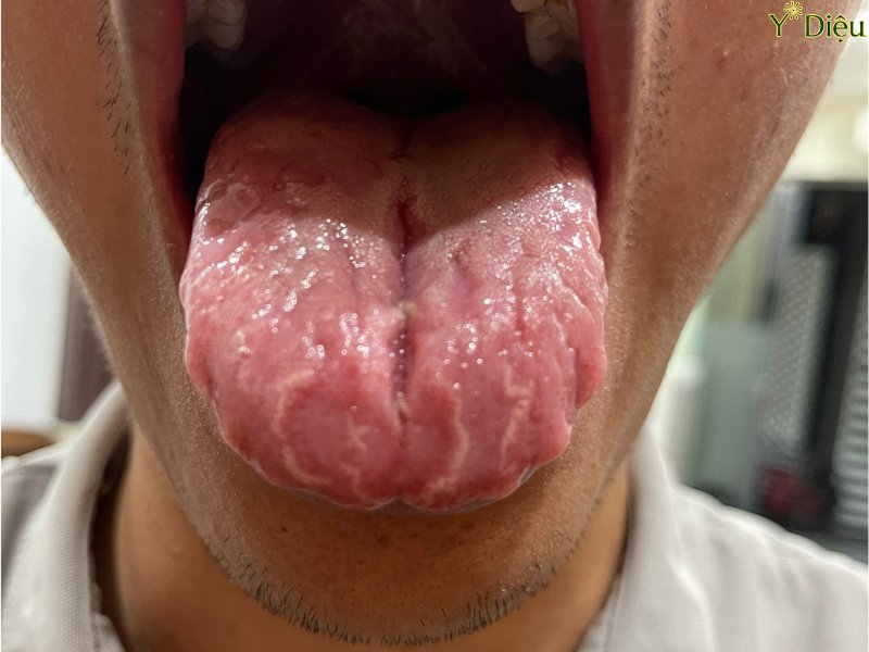 Lưỡi bị nứt sâu và đau rát khó chịu
