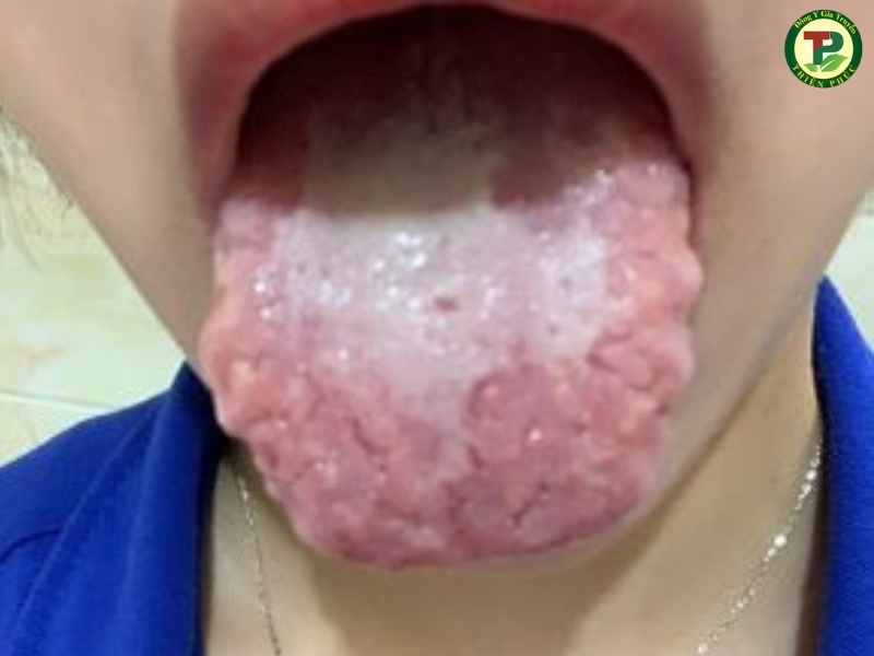 Hình ảnh viêm lưỡi bản đồ lâu năm