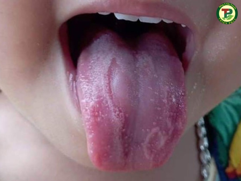 Lưỡi bị viêm gây đau rát khó chịu