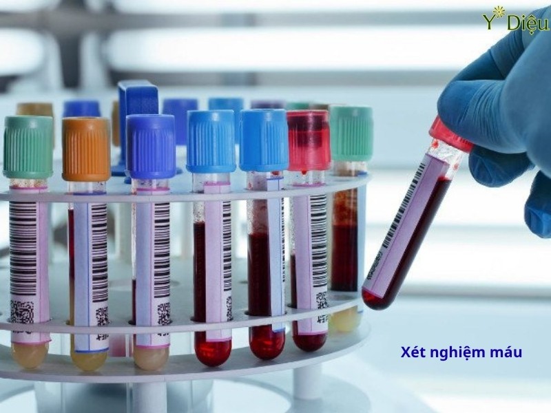Kiểm tra xét nghiệm máu định kỳ để biết các chỉ số về đường huyết